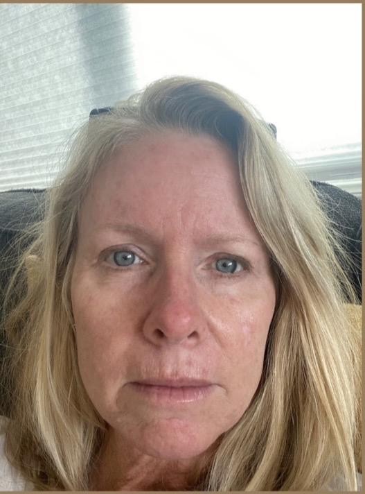 Micro-Needling Series — before