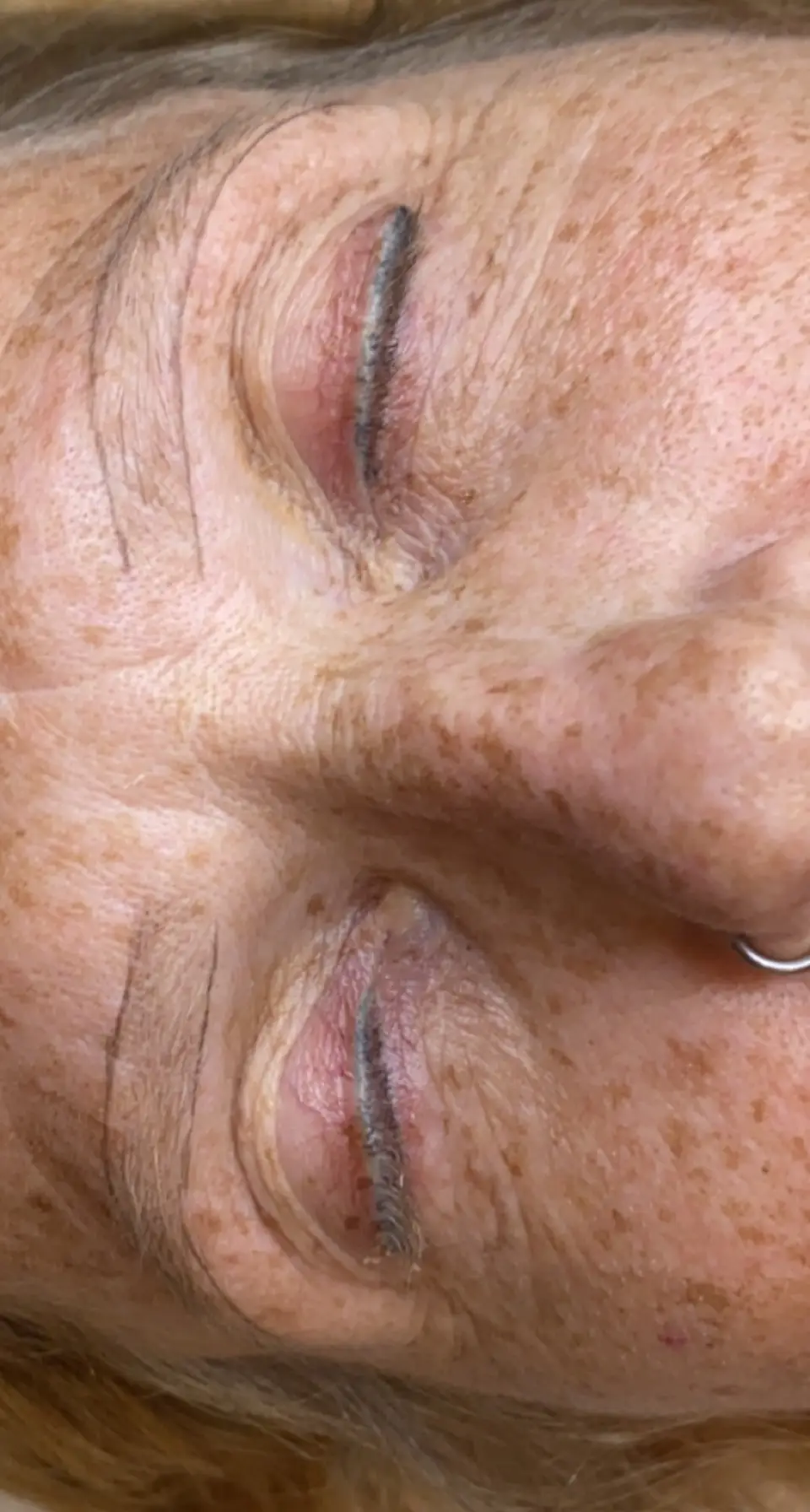 Cryo Facial — before